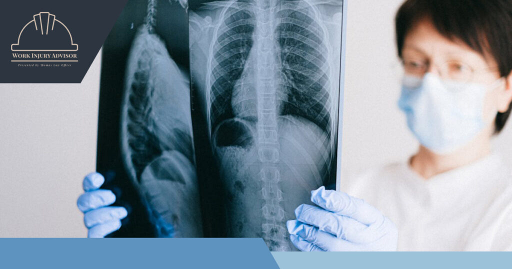 Does Workers' Compensation Cover Mesothelioma Treatment?